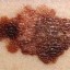 melanoma