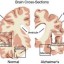 normal brain (L) & brain with alzheimer's (R)