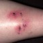 image of cat bite