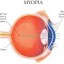 myopic eye