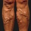 varicose veins
