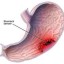 stomach cancer