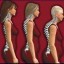 osteoporosis