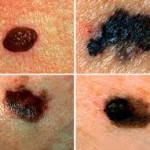 Ideas Galore Melanoma, A Benign Mole That Becomes Malignant - Ideas Galore